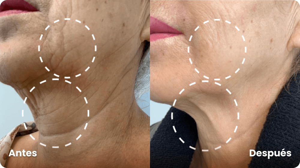 antes-y-despues-hilos-lisos