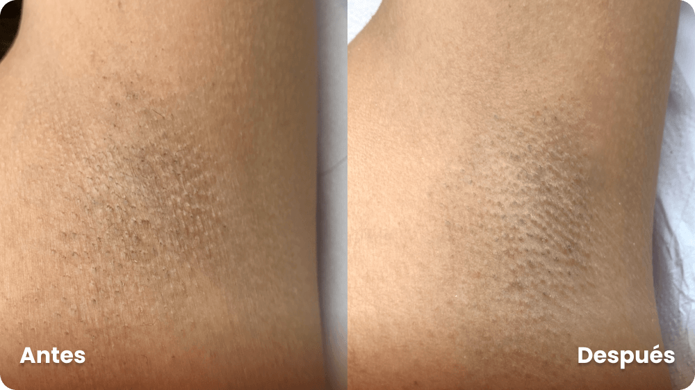 antes-y-despues-aclarant-intimate