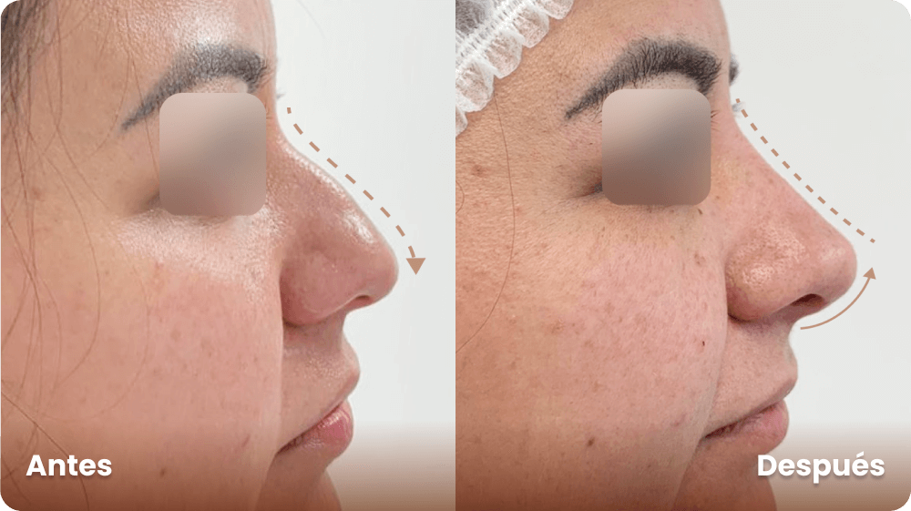 antes-y-despues-rinomodelacion