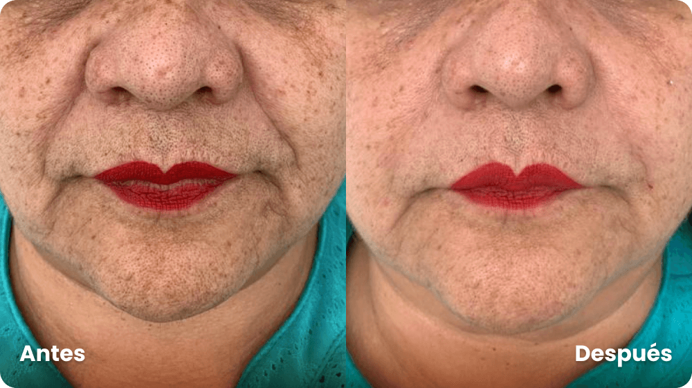 antes-y-despues-surcos-nasogenianos