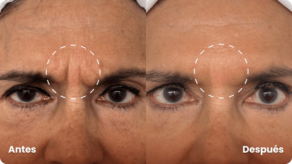 botox-entrecejo-antes-y-despues-lauderm