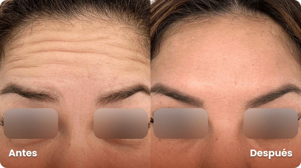 botox-frente-antes-y-despues-lauderm